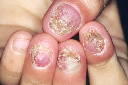 Khái quát về bệnh nấm móng chân tay