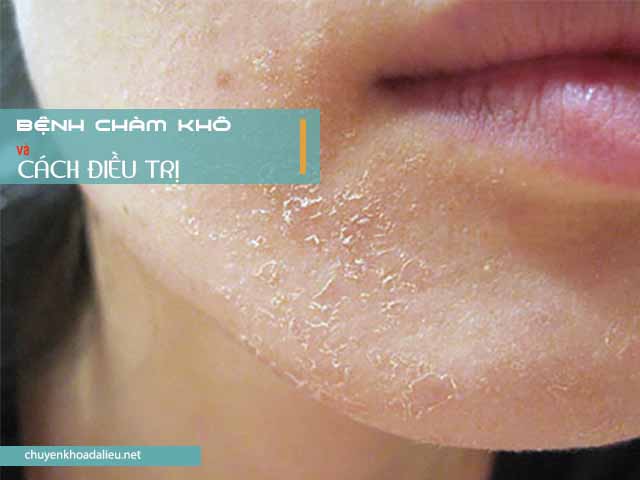 Bệnh chàm khô là gì