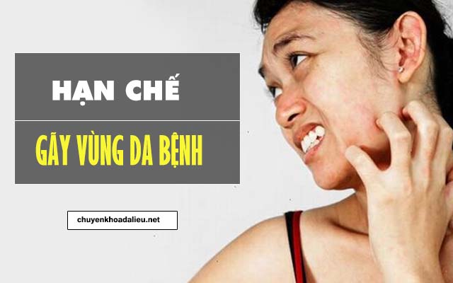 Biện pháp phòng ngừa bệnh chàm khô