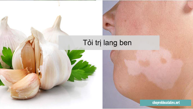 Tỏi trị lang ben nhanh chóng