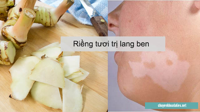 Cách chữa lang ben bằng củ riềng 