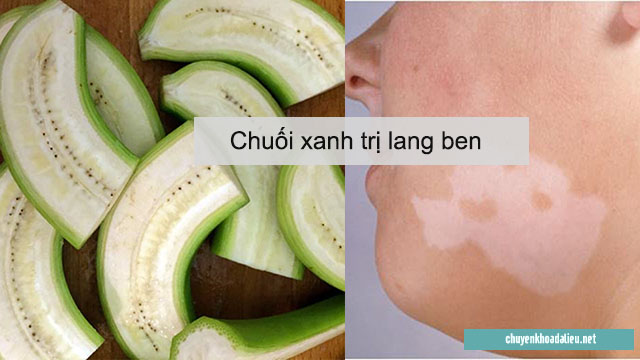 Điều trị lang ben bằng chuối xanh 