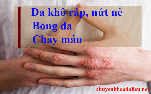 Một số dấu hiệu bệnh á sừng ở tay 