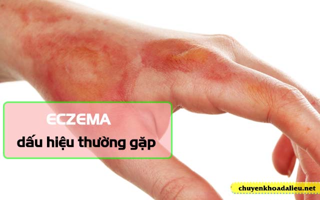 Một số dấu hiệu dễ nhận biết của Eczema