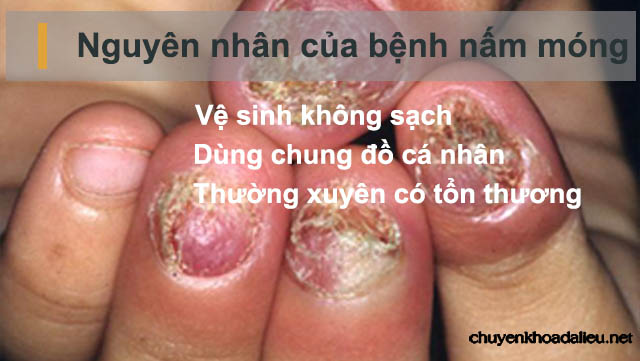 Nguyên nhân chính dẫn đế bệnh nấm móng