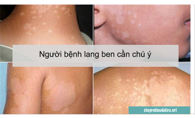 Những điều mà người bệnh lang ben cần chú ý