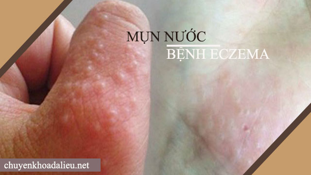 Mụn nước - Dấu hiệu của bệnh eczema