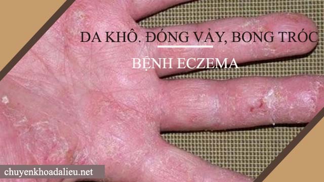 eczema làm da khô, đóng vảy và bong tróc