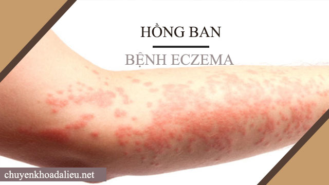 Dấu hiệu bệnh eczema - Hồng ban