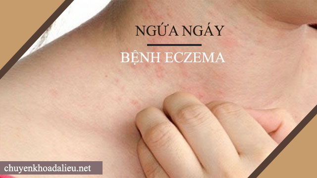 Ngứa da - Biểu hiện bệnh Eczema