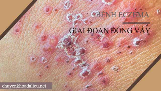 Biểu hiện của bệnh eczema giai đoạn đóng vảy