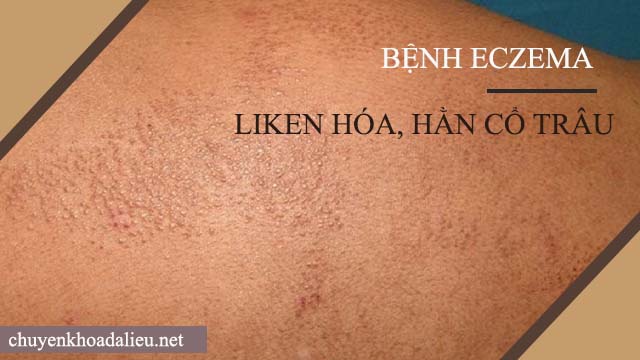 triệu chứng bệnh eczema là gì