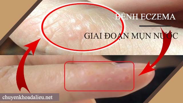 Dấu hiệu của bệnh eczema giai đoạn mụn nước