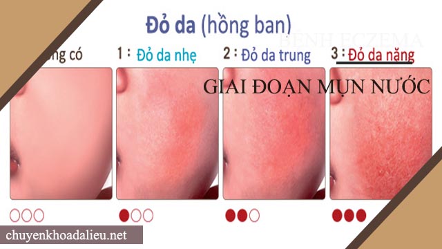 Triệu chứng của bệnh eczema giai đoạn hồng ban