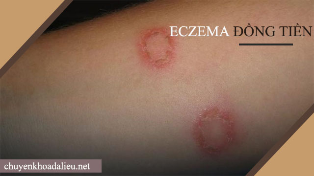 Bệnh eczema thể đồng tiền