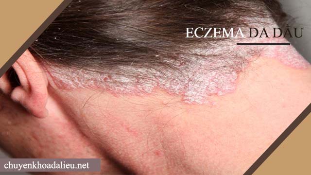 Bệnh Eczema da dầu