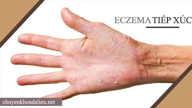 dấu hiệu bệnh eczema là gì