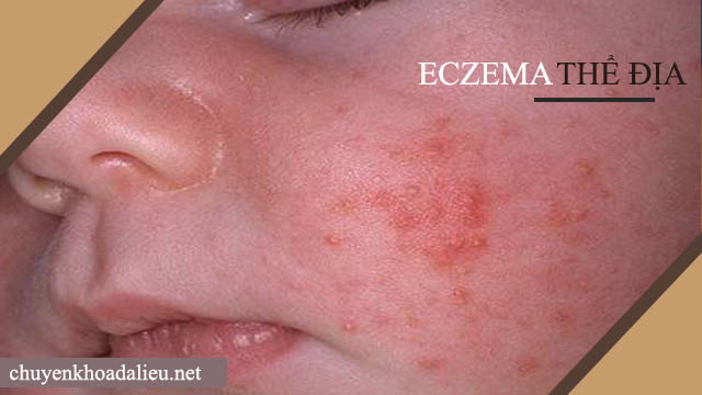 Dấu hiệu của bệnh eczema thể địa