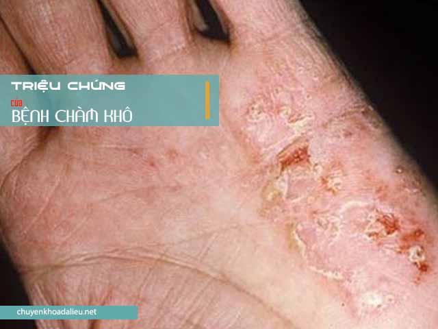 Triệu chứng của bệnh chàm khô