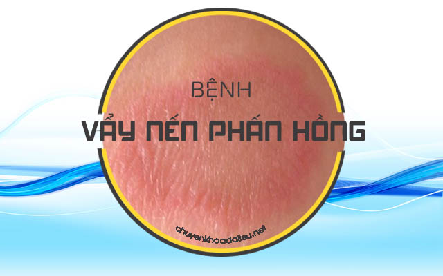 Bệnh vẩy nến phấn hồng