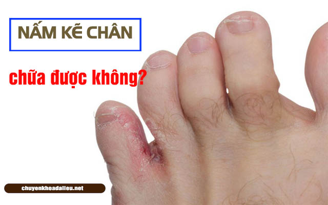 Bệnh nấm kẽ chân có chữa được không?