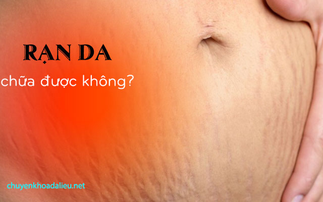 Rạn da có chữa khỏi được không