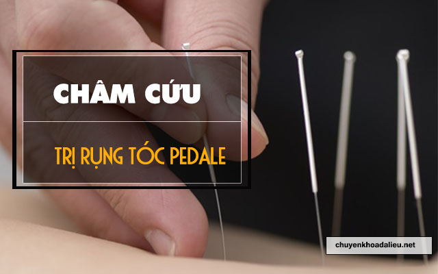 châm cứu để điều trị rụng tóc Pedale