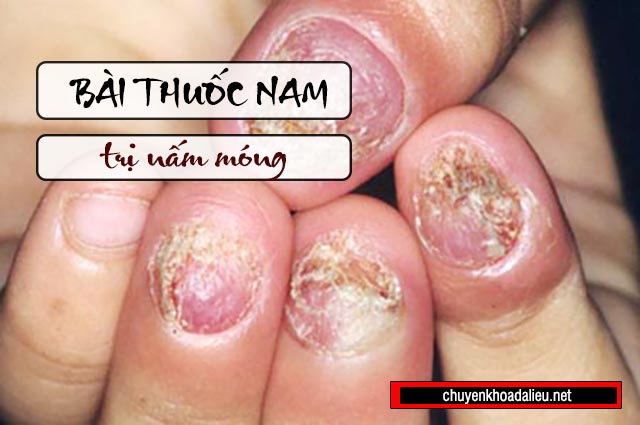 Bài thuốc nam chữa khỏi bệnh nấm móng 