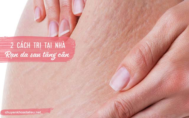 cách trị rạn da do tăng cân