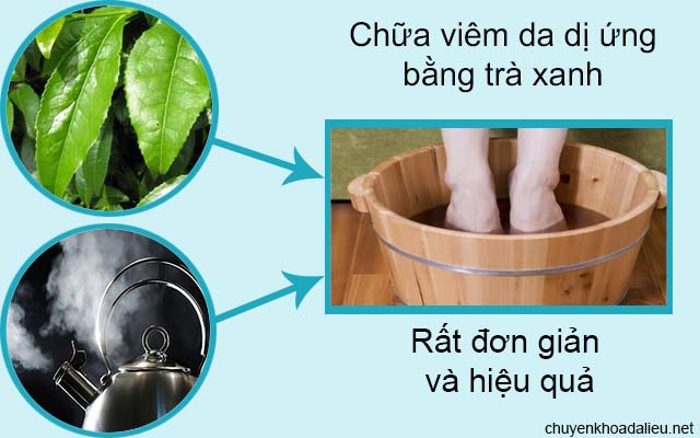 Cách trị viêm da dị ứng tại nhà