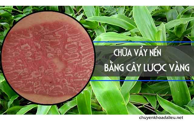 Cách chữa vẩy nến bằng cây lược vàng