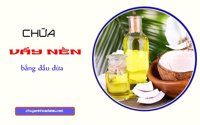 Chữa vẩy nến bằng dầu dừa