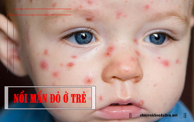 Hiện tượng nổi mẩn đỏ trên da ở trẻ 