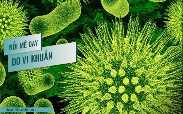 Nguyên nhân bị nổi mề đay do nhiễm vi khuẩn, virus