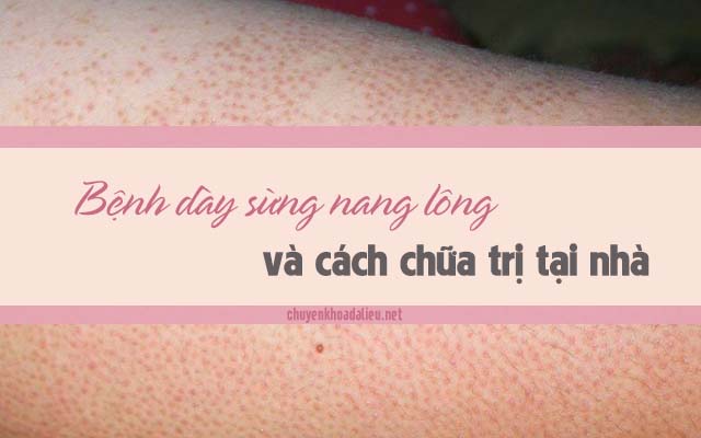 bệnh dày sừng nang lông