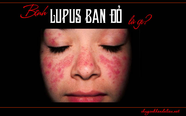 Một số thông tin cần biết về bệnh Lupus đỏ