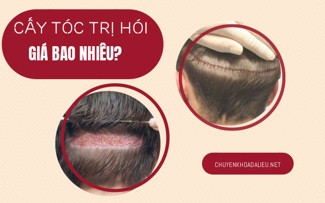  bảng giá cấy tóc trị hói