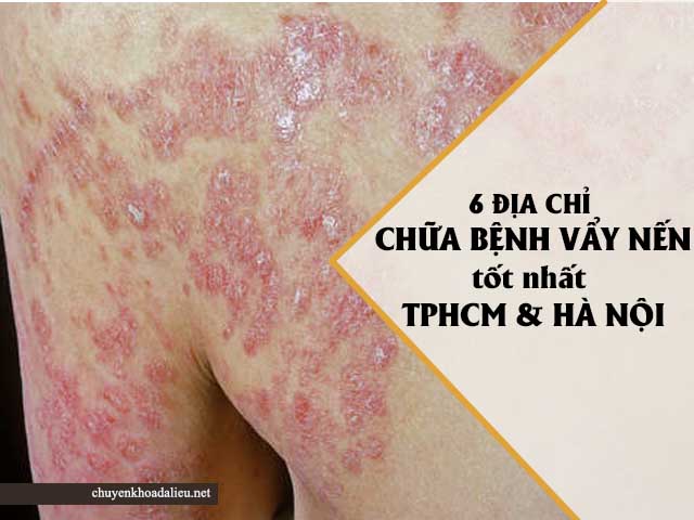 chữa bệnh vẩy nến ở đâu