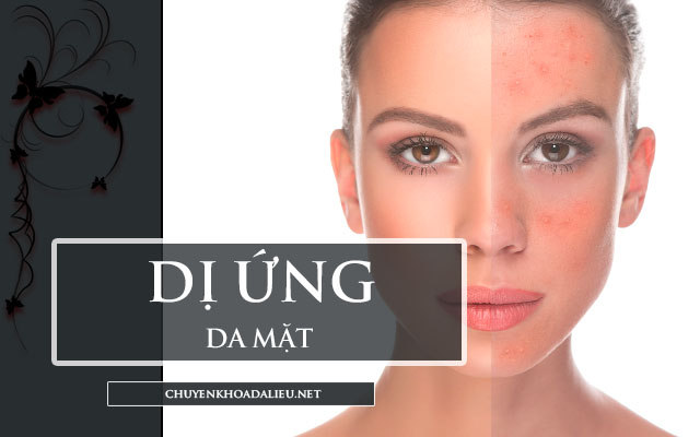 dị ứng da mặt