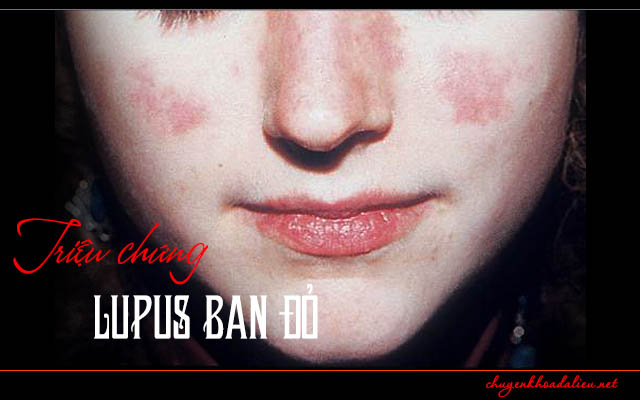 Triệu chứng lupus ban đỏ