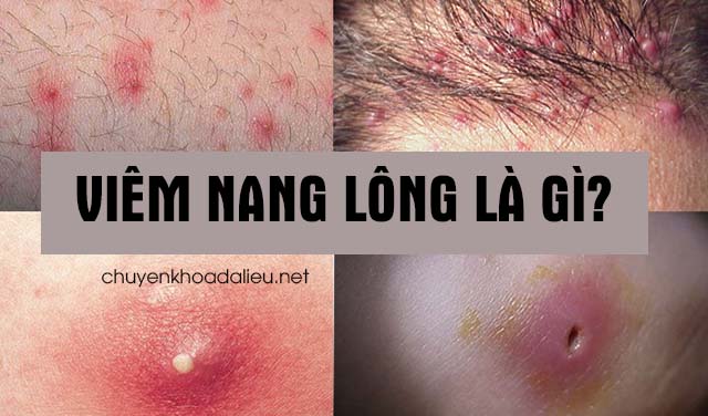 Viêm lỗ chân lông là gì