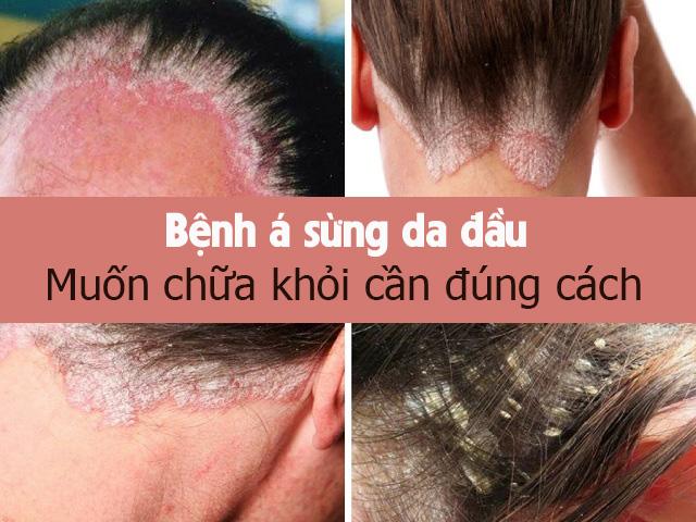 Bệnh á sừng da đầu