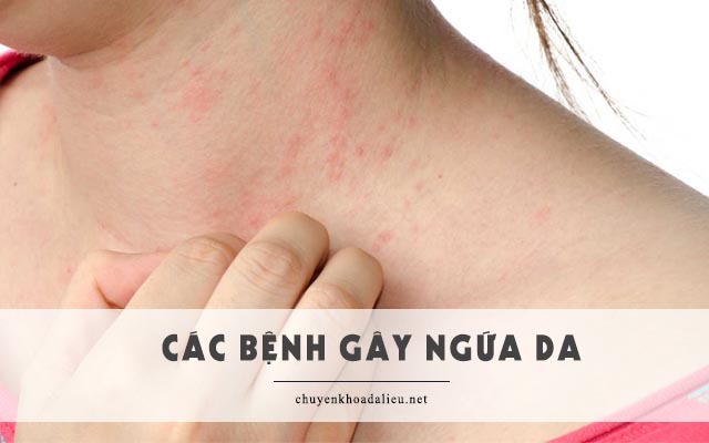 các bệnh gây ngứa da