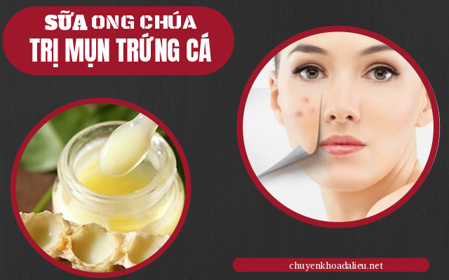 sữa ong chúa trị mụn trứng cá