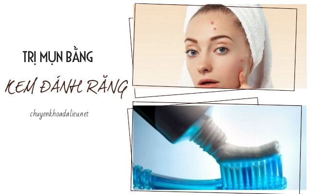 trị mụn bằng kem đánh răng