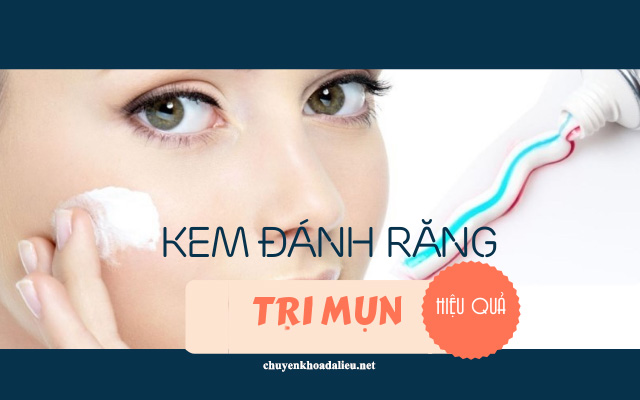 Cách trị mụn đầu đen tại nhà bằng kem đánh răng