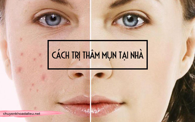 cách trị vết thâm mụn tại nhà