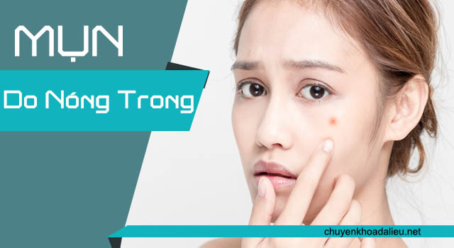 Cách trị mụn do nóng trong giúp bạn hạ hỏa tức thì