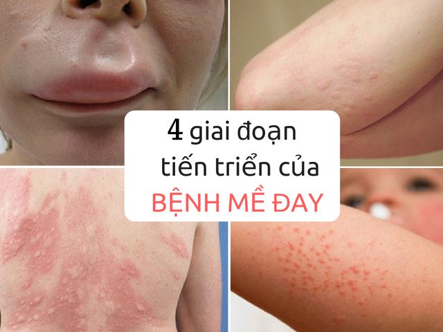 Các giai đoạn phát triển của bệnh mề đay