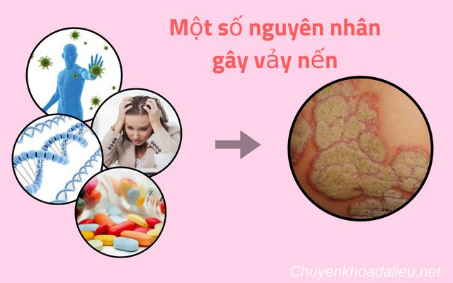 những nguyên nhân gây bệnh vẩy nến 